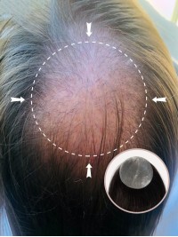 3"X 3" Echthaar-Cover-Up-Haarpflaster Auf Voller Hautbasis - Keine Chirurgische Lösung Für Alopecia Areata | 12"