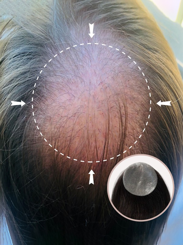 3"X 3" Echthaar-Cover-Up-Haarpflaster Auf Voller Hautbasis - Keine Chirurgische Lösung Für Alopecia Areata | 12"