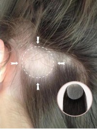 2"X 2" Echthaar-Cover-Up-Haarpflaster Auf Voller Hautbasis - Keine Chirurgische Lösung Für Alopecia Areata | 12"